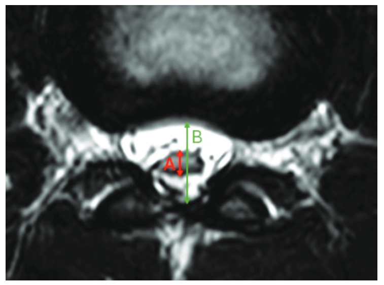 ารวัด cord-sac ratio เส้นหัวลูกศรสีแดง A  แสดงเส้นผ่านศูนย์กลางของ spinal cord หรือ neural placode, เส้นหัวลูกศรสีเขียว B แสดงเส้นผ่านศูนย์กลางของ thecal sac