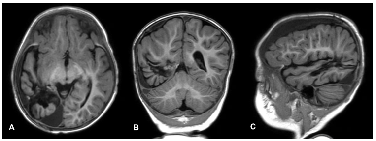 Follow-up T1-weighted magnetic resonance imaging of the brain demonstrating no evidence of tumor recurrence. (A) Axial T1-weighted image, (B) Coronal T1-weighted image, (C) Sagittal T1-weighted image. 