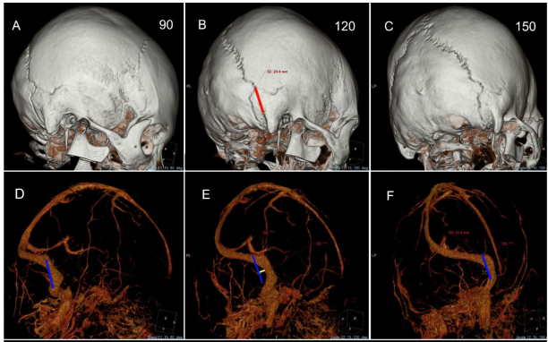 The 3D reconstruction images with and without bone window at rotational angles 